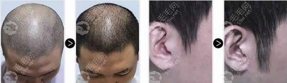 头发种植+鬓角种植效果案例
