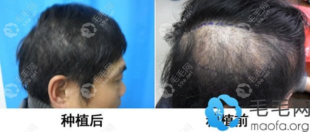 植发手术来治疗斑秃效果对比