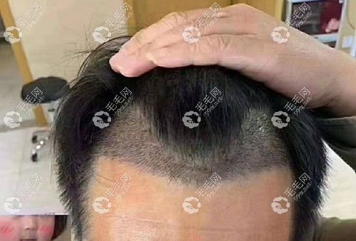 男士M型发际线种植2025单位