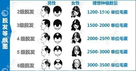 额头越高植发费用会越高