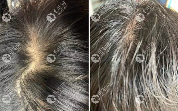 螺内酯使用6个月后的治脱发效果