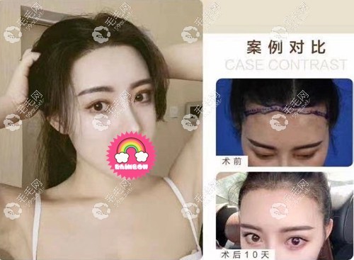 女士发际线调整1500毛囊单位