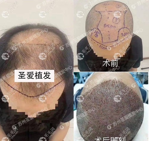 大面积种植/前额发际线种植