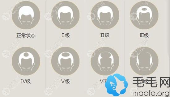 脱发情况的不同分级