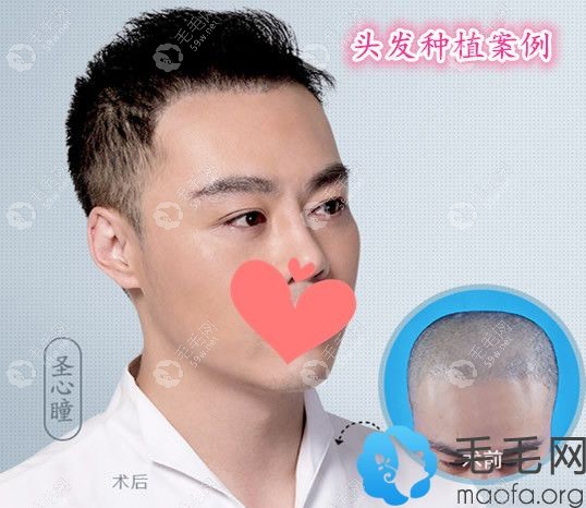 在上海美萊毛發(fā)移植中心做頭發(fā)種植案例前后對比效果展示