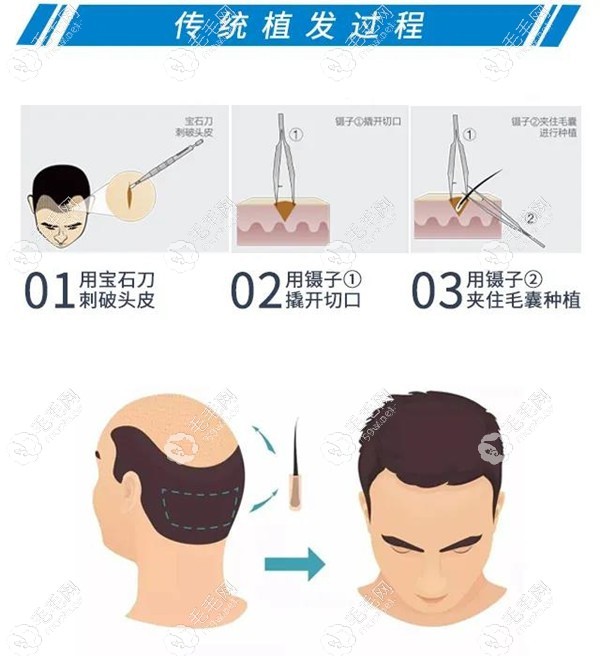 FUE寶石刀植發(fā)技術(shù)過程