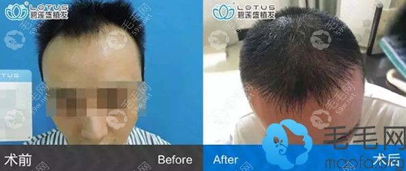 沈阳碧莲盛周宗贵发际线种植4000单位10个月的恢复效果图