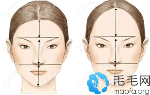发际线后移显得额头大