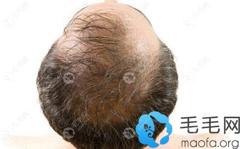 为什么脱发从头顶开始