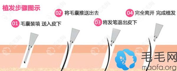 深圳富华微针植发技术原理