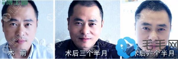 沈阳博士园植发男士额角植发前后效果对比照片