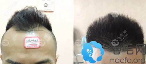 钱先生种植发际线一年的效果对比照片
