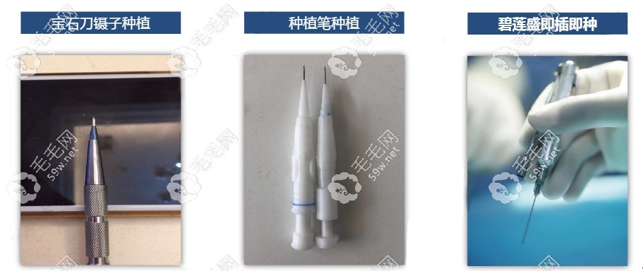 重慶植發(fā)不同技術(shù)器材的區(qū)別