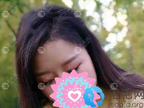 植发际线术后三个月的效果图