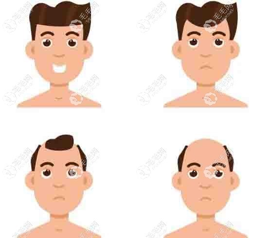 男性脱发过程
