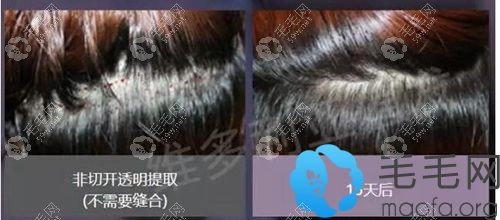 不用剃掉后枕部位头发植发案例