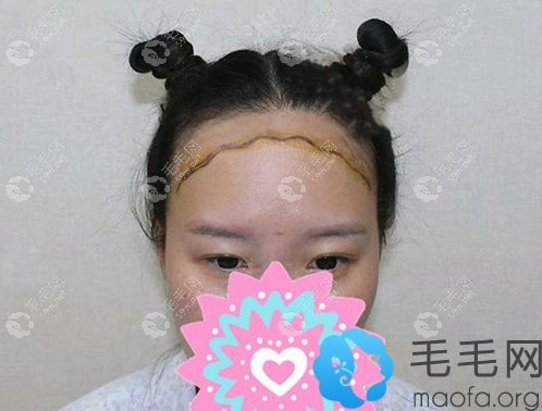 佛山顺德壹加壹做发际线种植