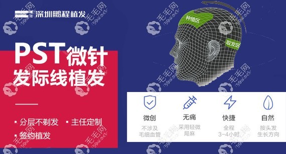 深圳鹏程PST植发技术优势