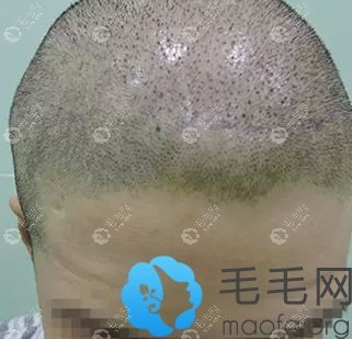 上海碧莲盛周宗贵加密植发第1天图片