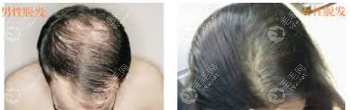 女性脱发和男性脱发的区别