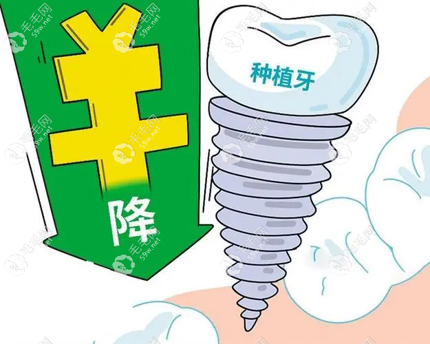2023山西種植牙集采價格表