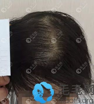 头顶稀疏加密植发前
