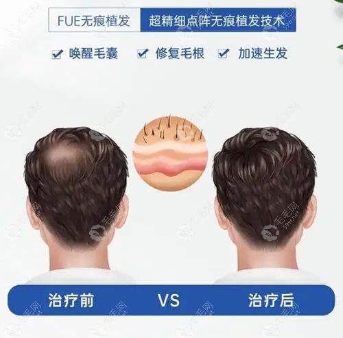 济南植发正规医院指南