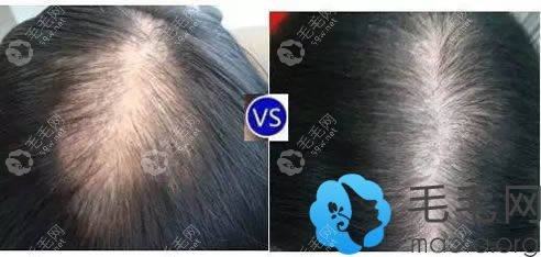 女性脱发植发成功案例