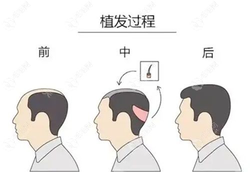 前额植发1000/1500/2000单位价格明细