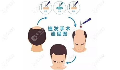 男生植发的灵魂拷问