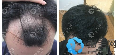 男性脱发植发案例效果图