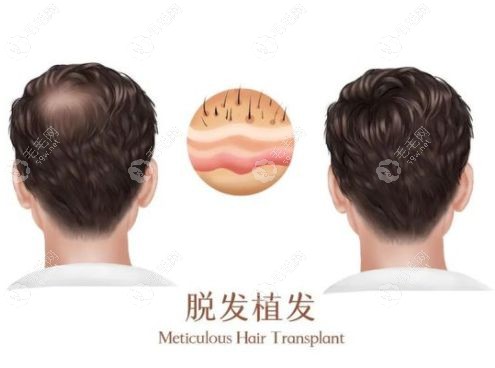 男生植发一年真实成效全阶段记录