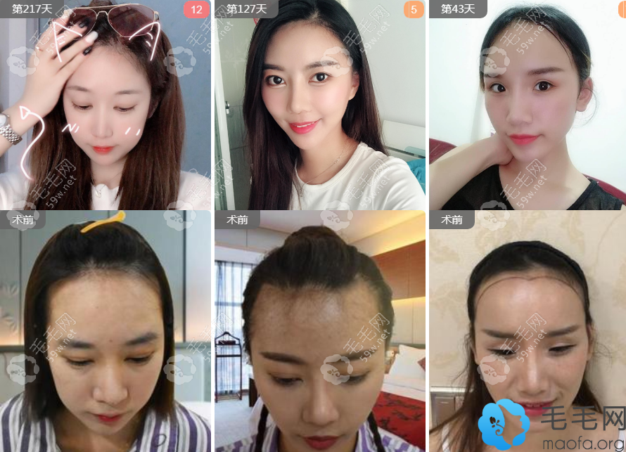 圣愛女性發(fā)際線植發(fā)案例