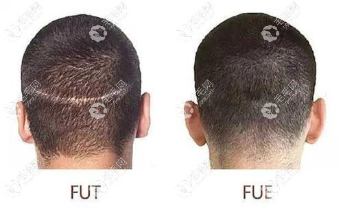 FUT植发技术和FUE植发技术取发后后枕部对比图