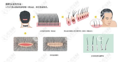 FUT隐痕植发手术过程