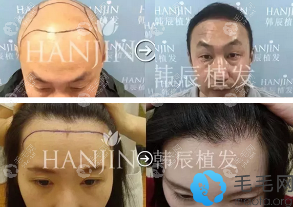 南京韩辰植发效果案例