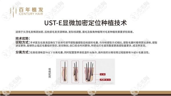 常州百年植发一单位多少钱