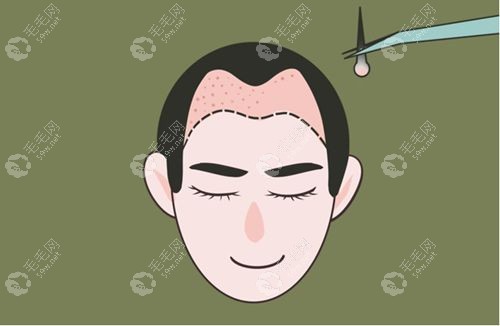 男士发际线种植多少钱
