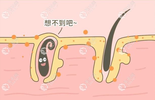 圣爱的新提取仪可以提取长得不直的毛囊哦