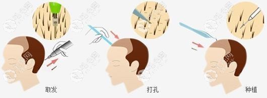 肤康的FUE植发过程