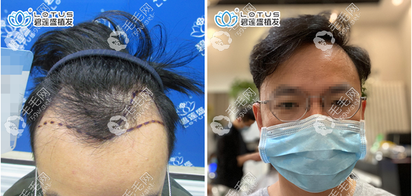 福州碧莲盛植发效果怎么样