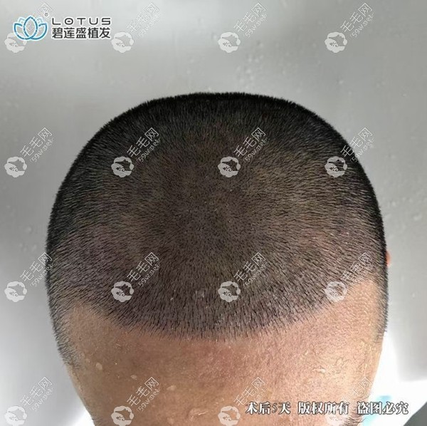 碧莲盛前额植发效果图
