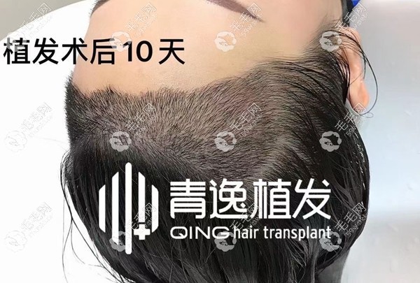 青逸女士发际线植发效果
