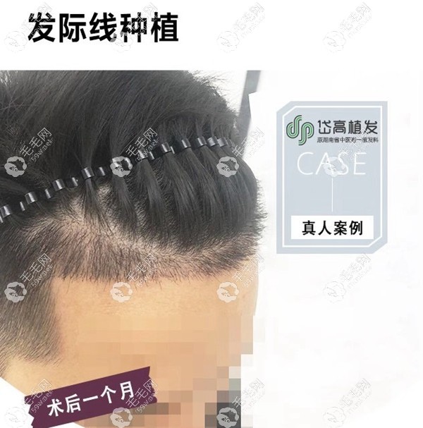 岱高发际线植发效果图