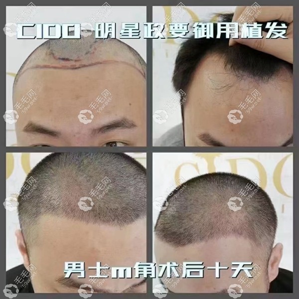 熙朵连锁人工植发效果