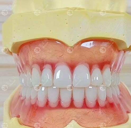 成都极光口腔吸附性义齿成效实测