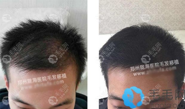 头发种植案例