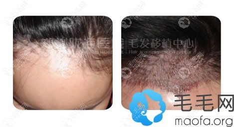 美人尖种植案例