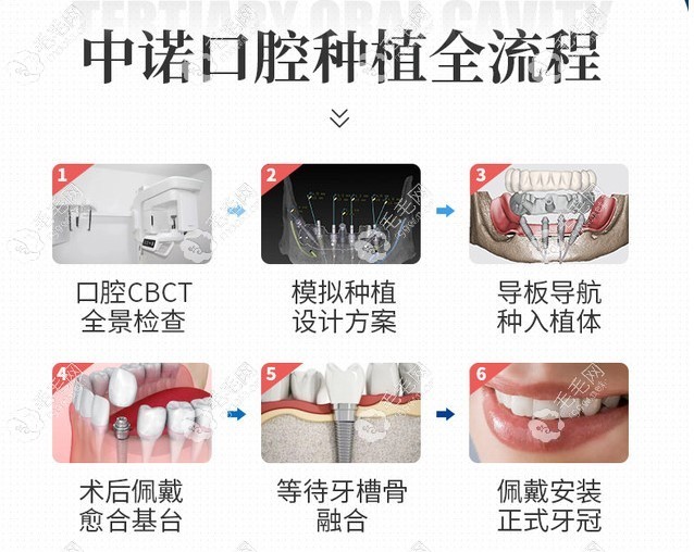 北京中諾口腔醫(yī)院種植牙全流程
