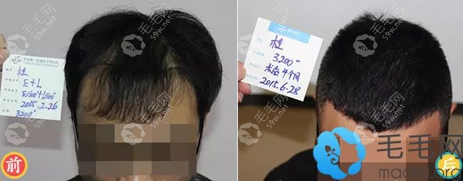 上海雍禾植发案例4个月效果图